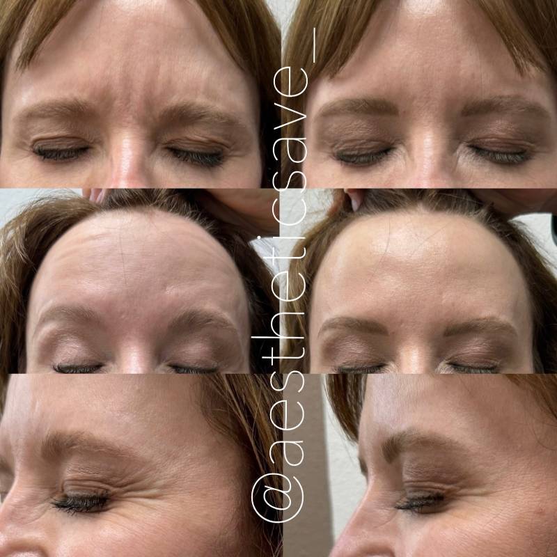 Lip flip Botox