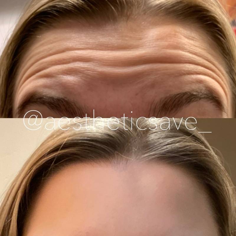 Bunny lines treatment