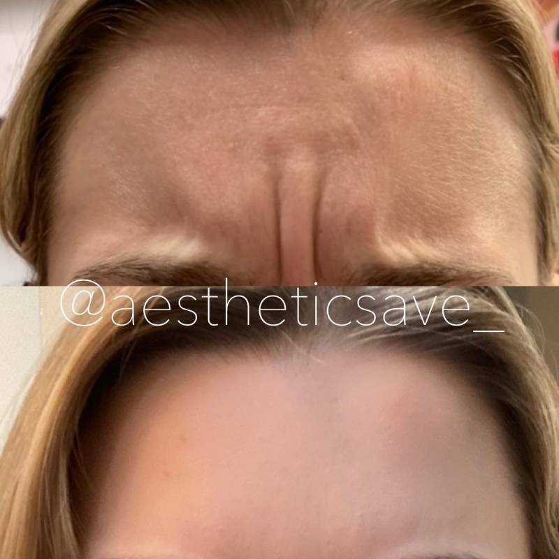 Neck Botox injections