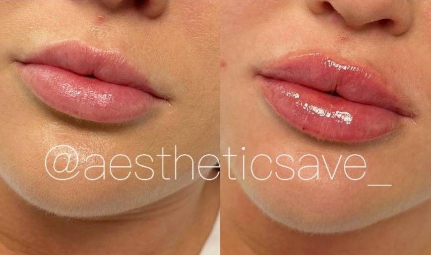 Glabella Botox treatment