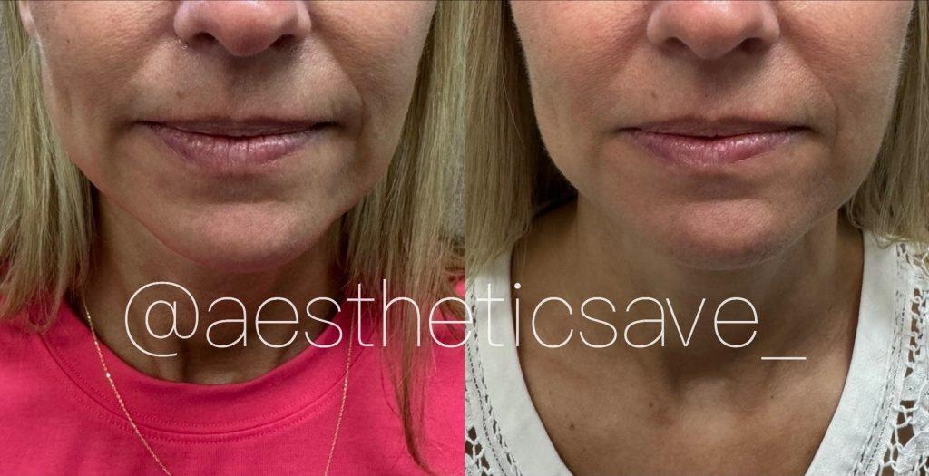 Facial slimming Botox