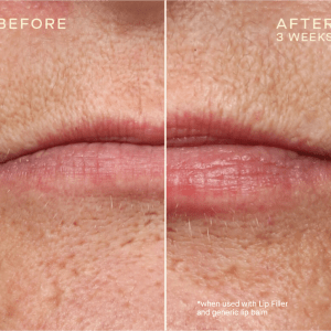 Jawline contouring