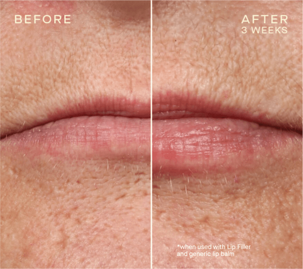 Jawline contouring