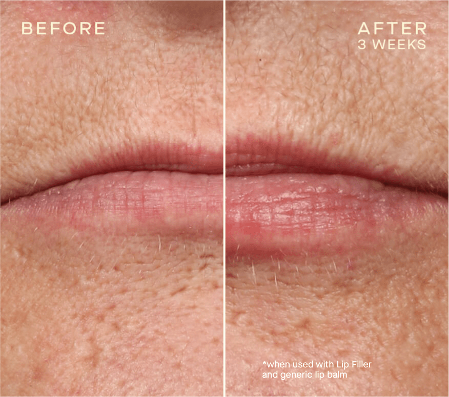 Jawline contouring