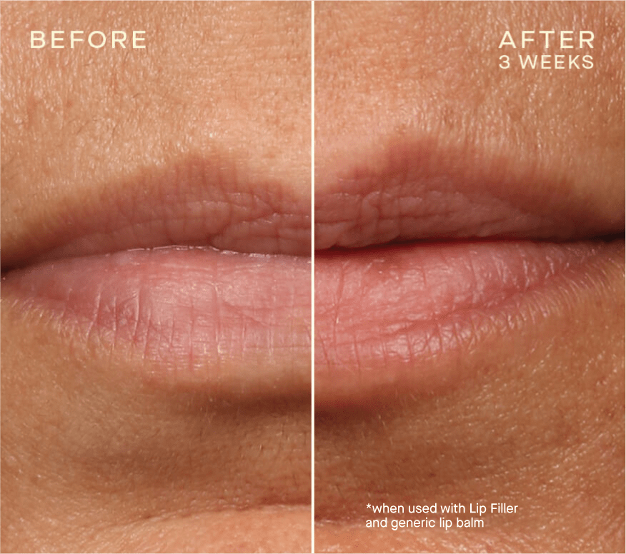 Lip Filler / Refill